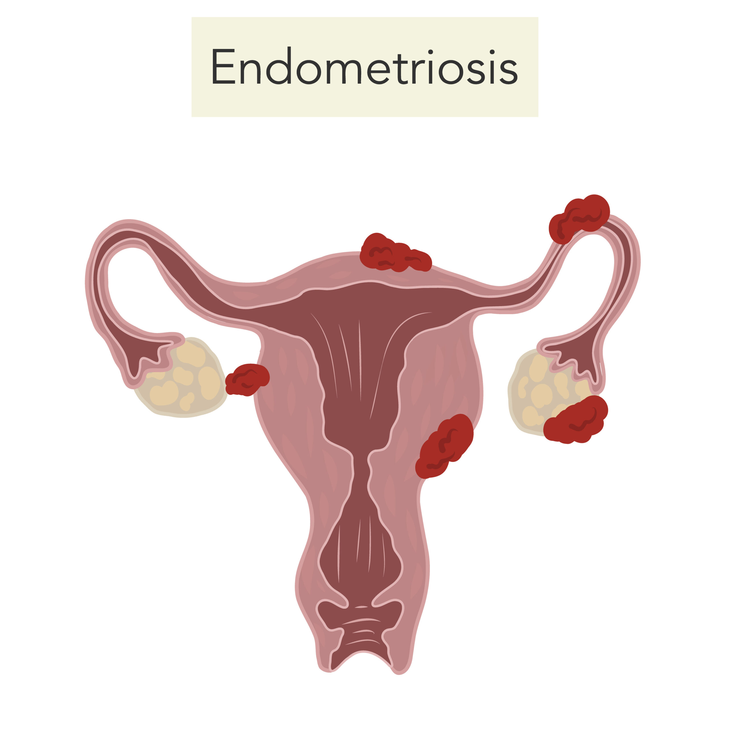 Endometriosis female disease reproductive system