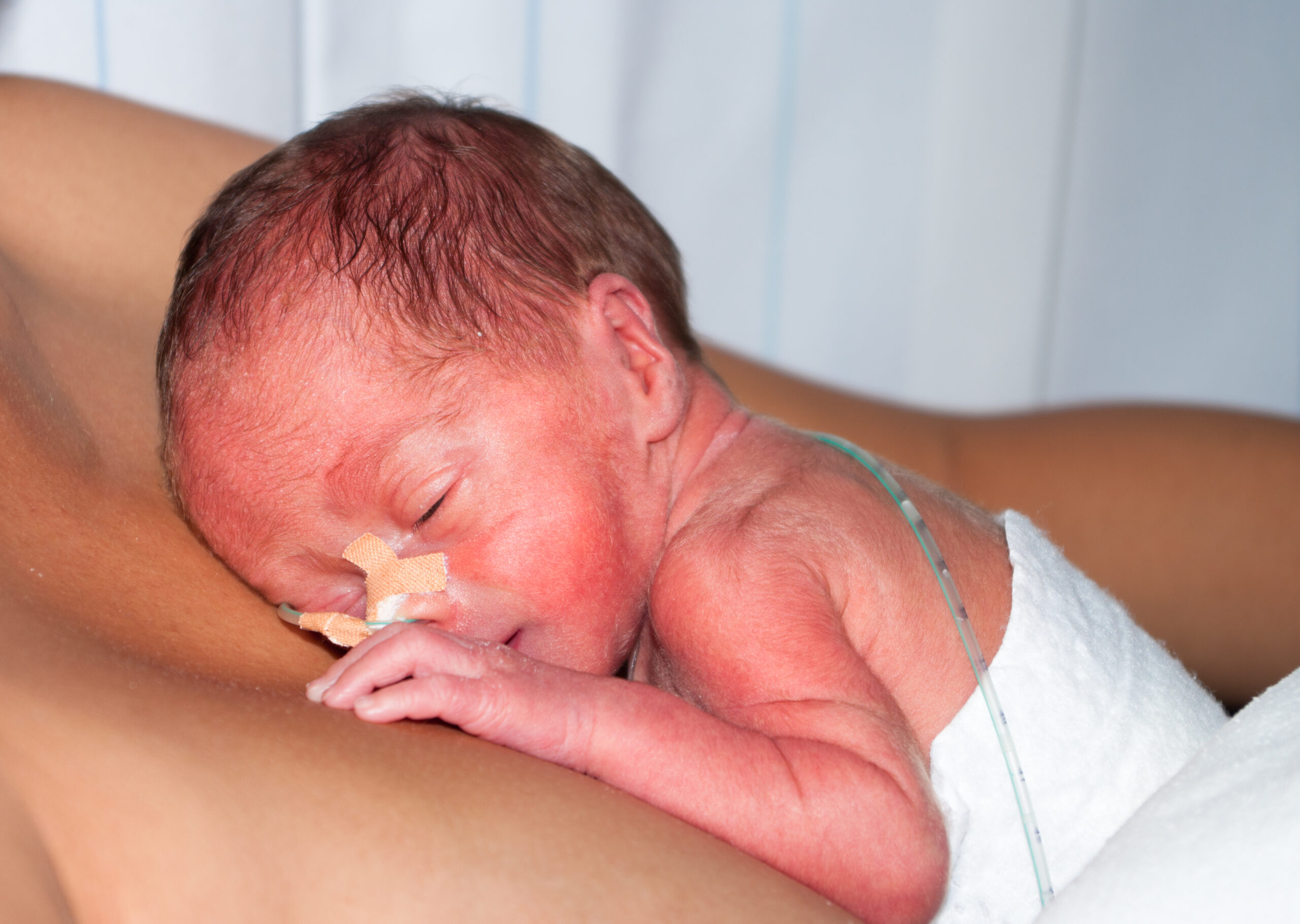 A premature baby laying on the moms chest with an IV