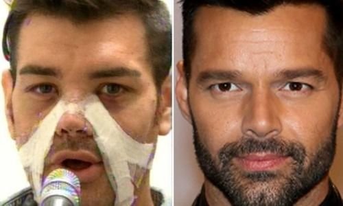 Fran Mariano gets plastic surgery to look like Ricky Martin