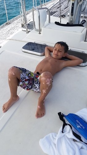 niño tomando sol vitiligo