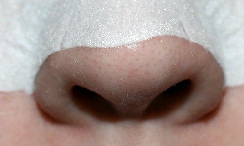 nose, blackheads