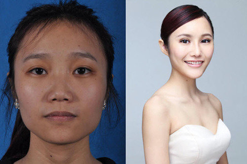 asian before and after