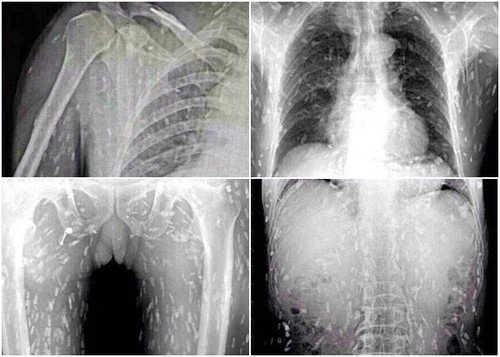 x-rays of man with tapeworms