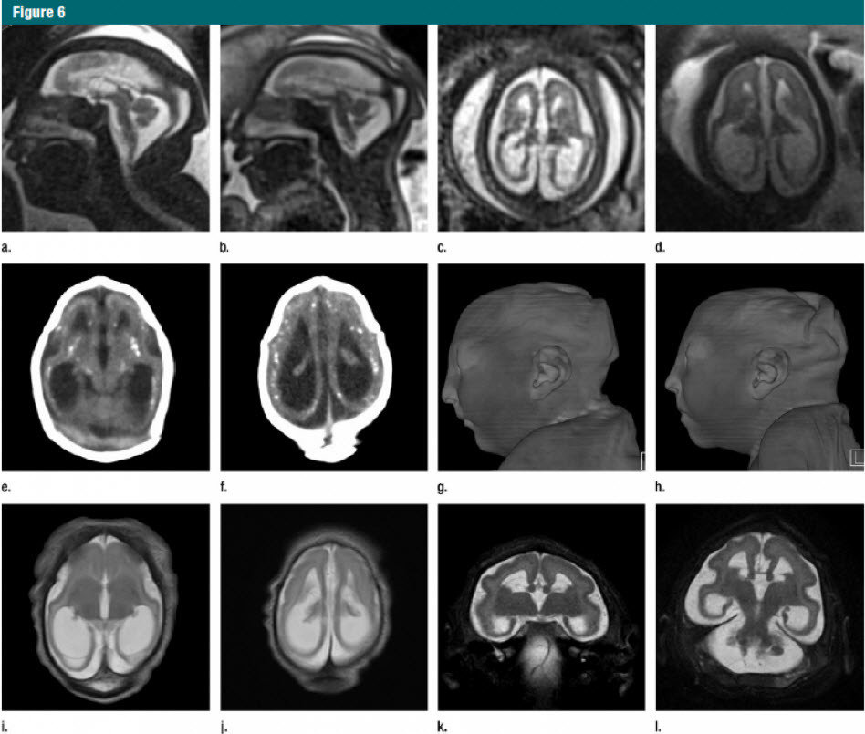 brain