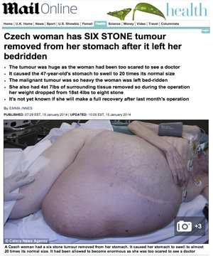 Czech woman has huge tumor removed