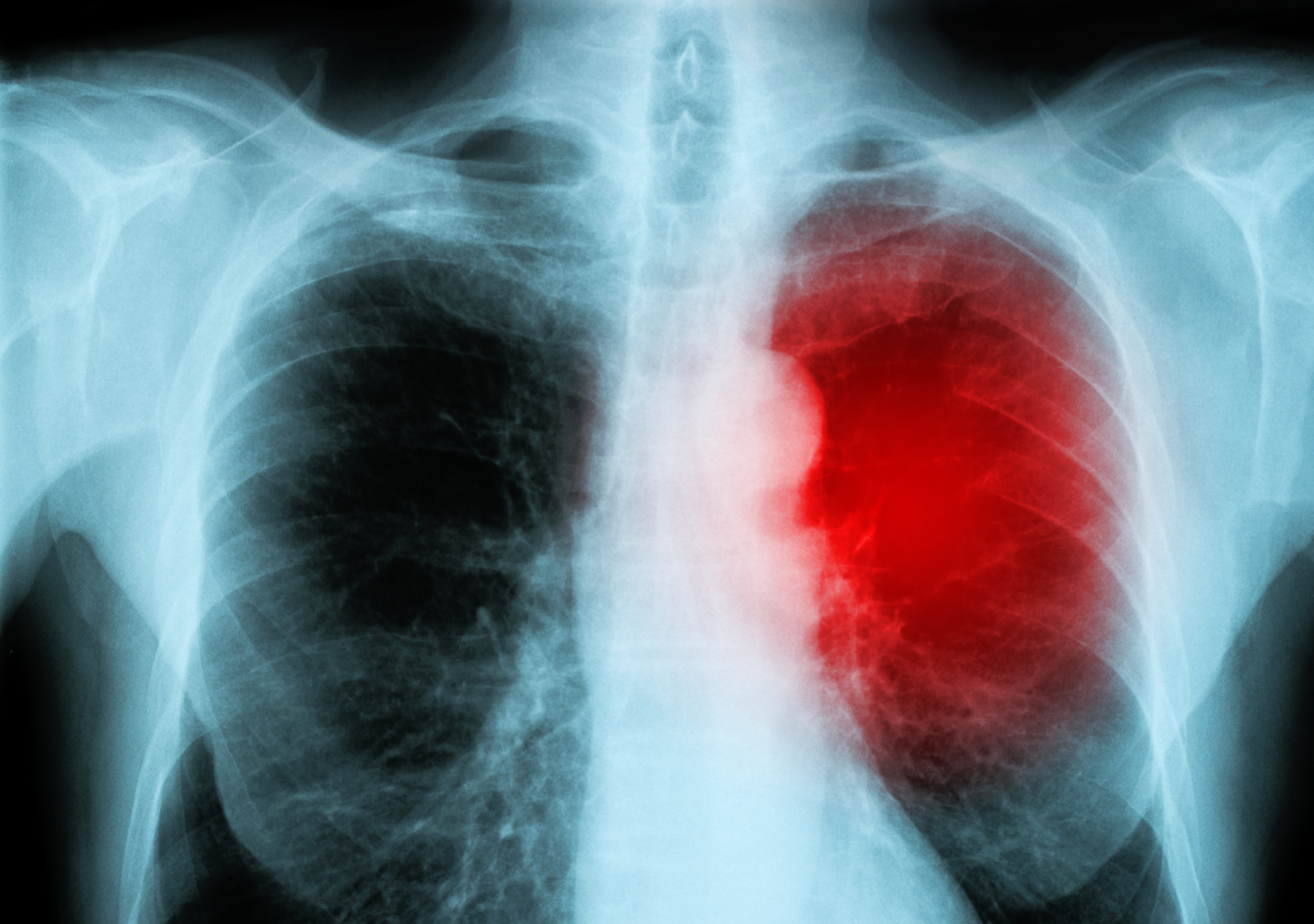 x-ray red heart of human (heart disease)