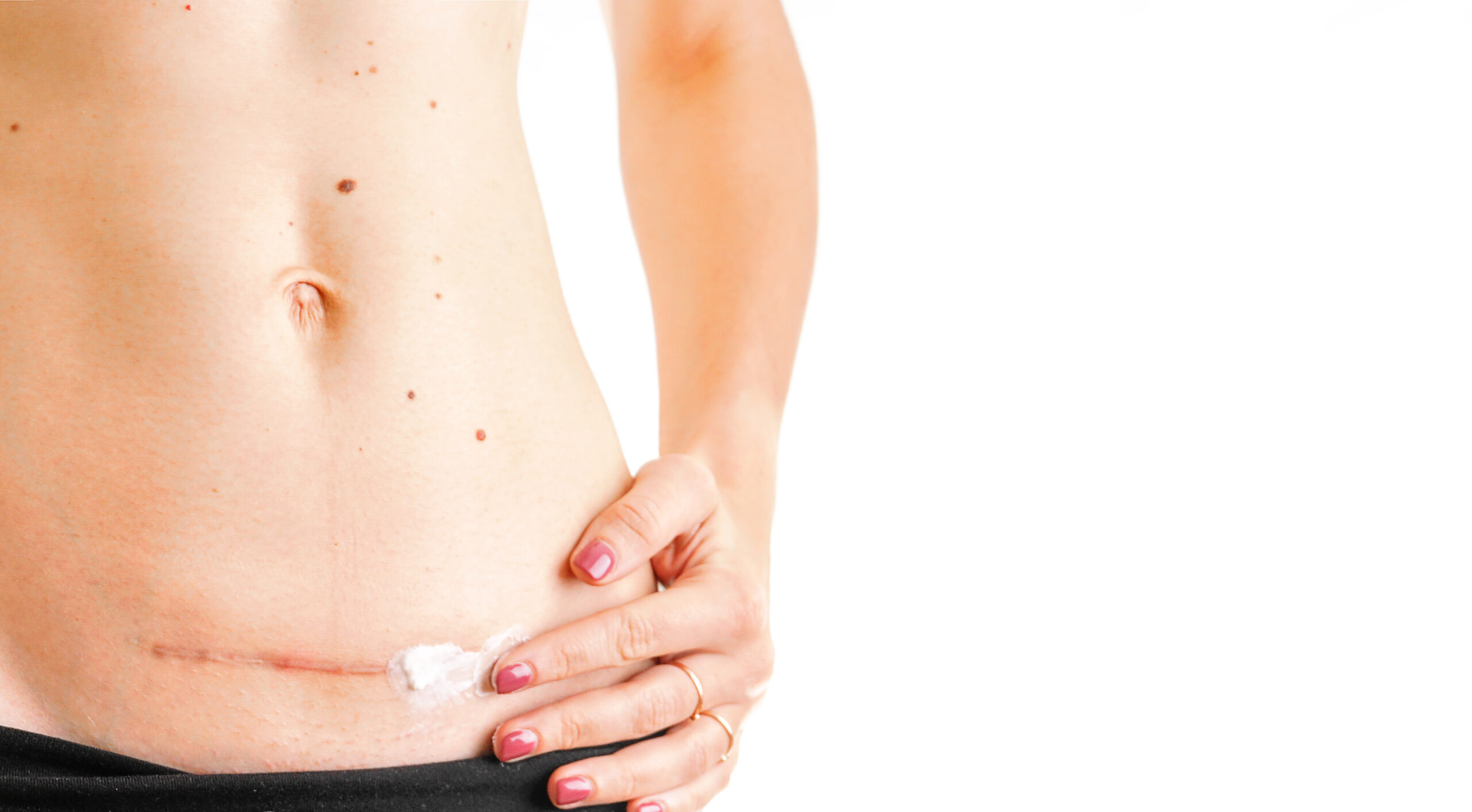 woman belly with scar c Cesarean healing cream medicine isolated white background concept
