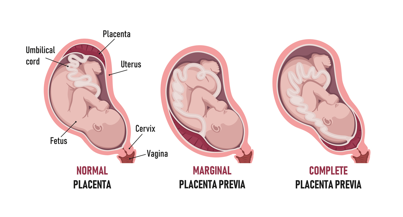 Placenta previa: normal , Partial, Marginal (Low-lying), Complete