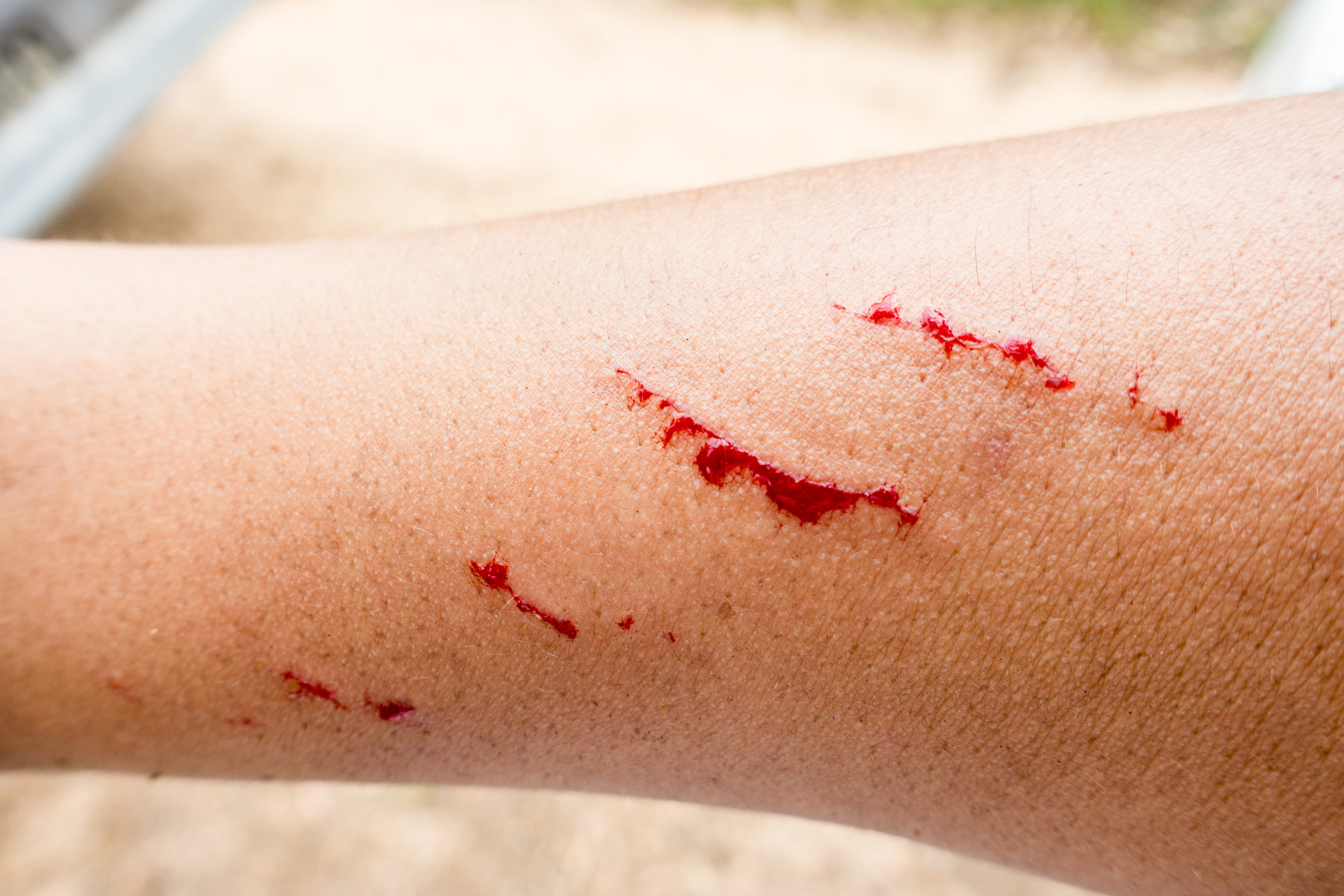 Selective focus of fresh wound with blood, A man showing a lesion under his arm, Accident wound marks on the left hand side, Injuries from falling on street.