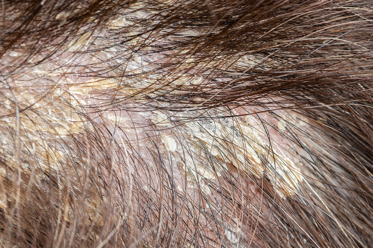 woman's dandruff in the hair and scalp