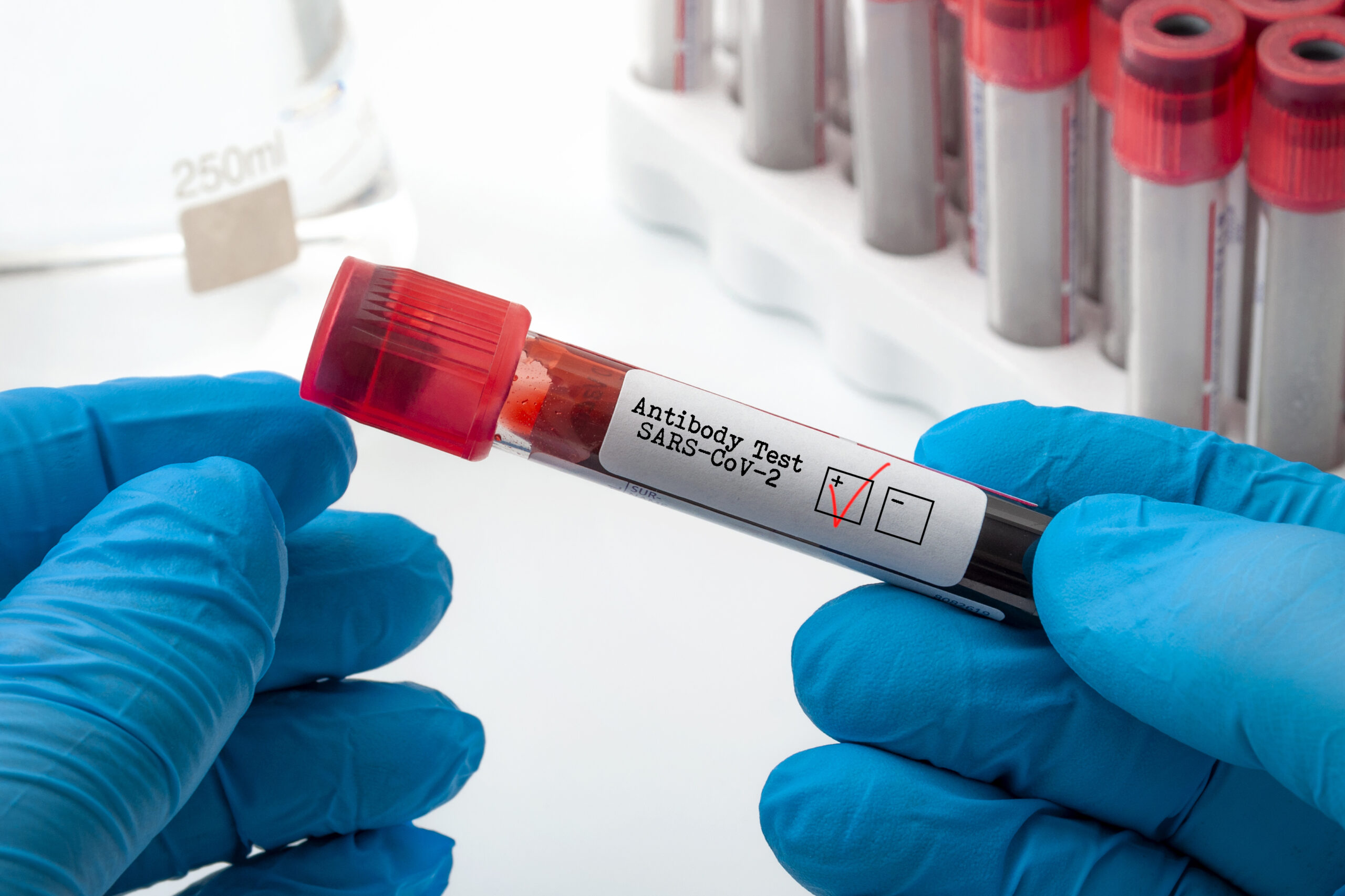 Novel coronavirus clinical antibody testing and Covid-19 diagnostic concept with doctor holding blood plasma sample used to test for SARS-CoV-2 antigen with a red check in the positive box