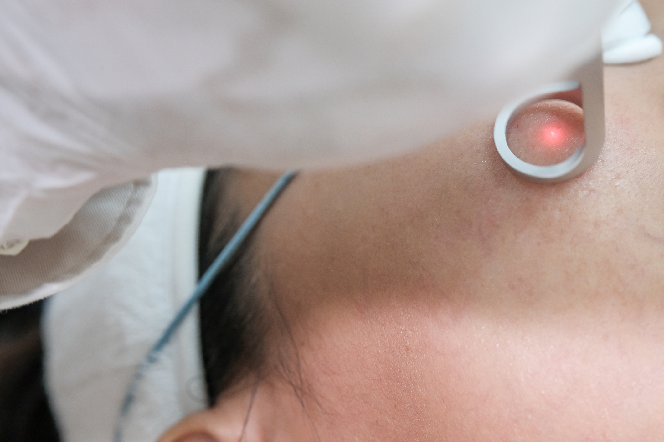 Close up of a woman getting laser face treatment procedure in medical salon center. Skin rejuvenation and beauty concept