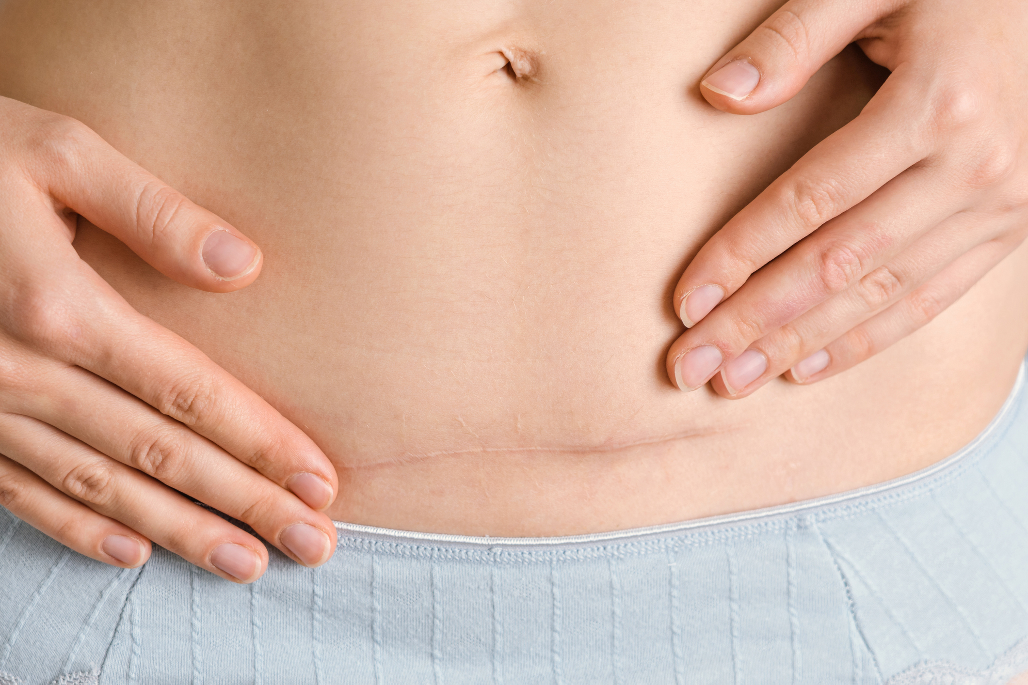 Close-up of a woman's abdomen after a cesarean section a year later. Healing scar after surgery