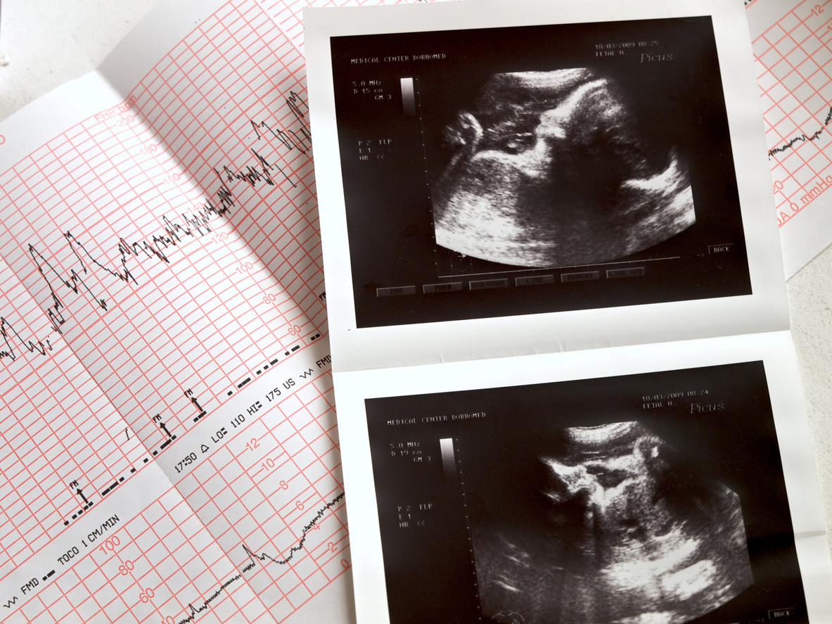 Ultrasound and analuses of the fetus