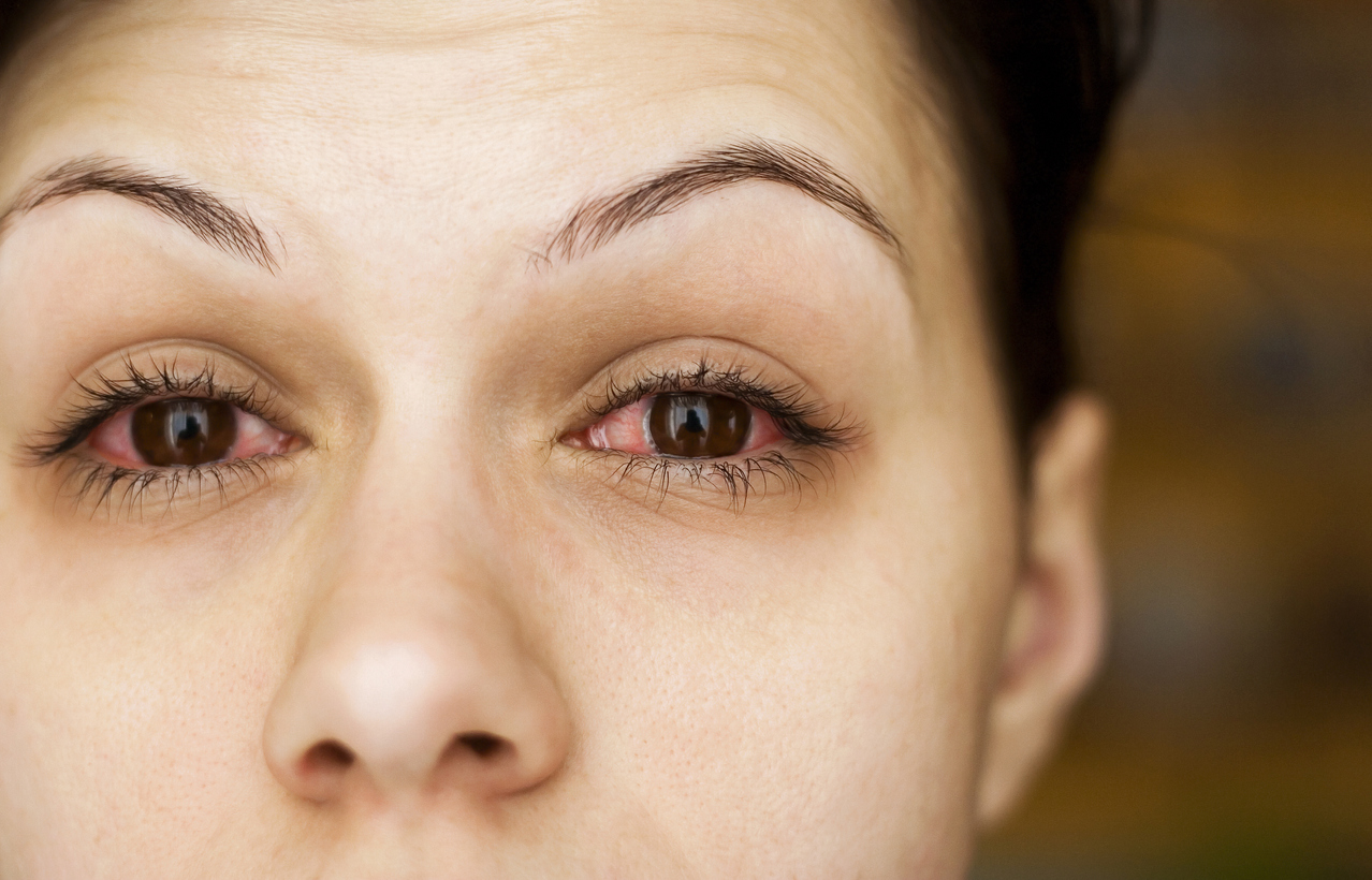 Close-up of woman with pink whites of her eyes