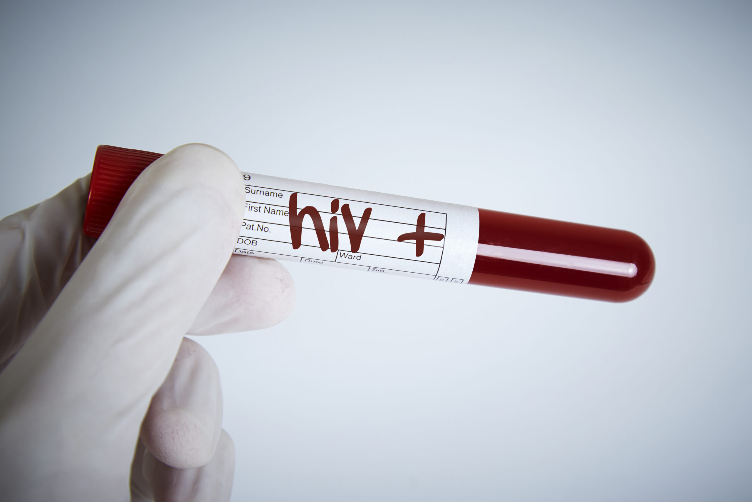 Hiv Test, Hiv Positive