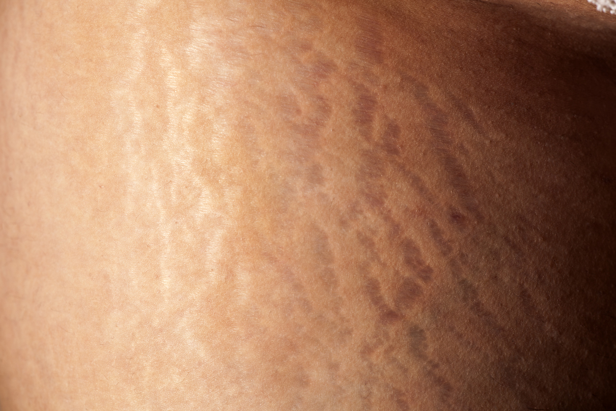 Female stretch marks