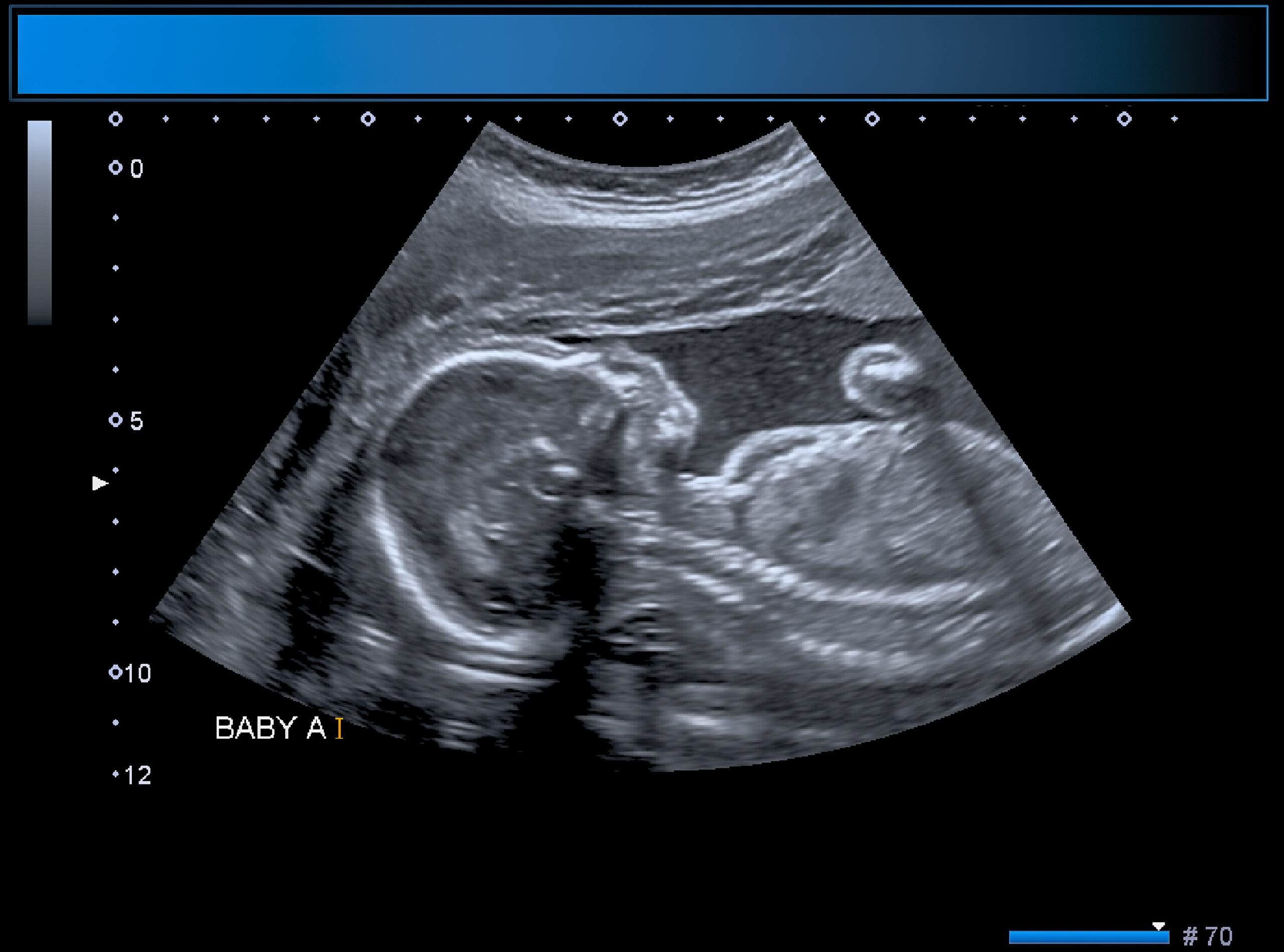 Identical twin boy obstetrical ultrasound